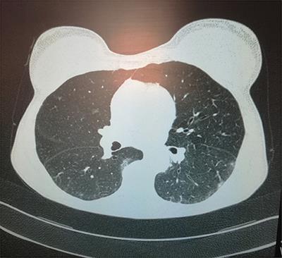 Case Report: Emergency CABG Following Failure of PTCA in a COVID-19 Patient